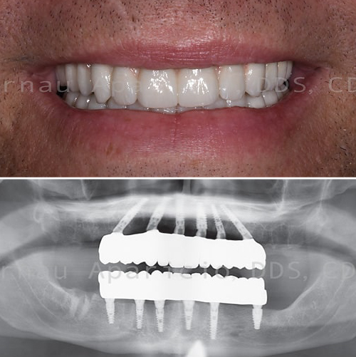 Dental implants & permanent bridge in a very short time-02