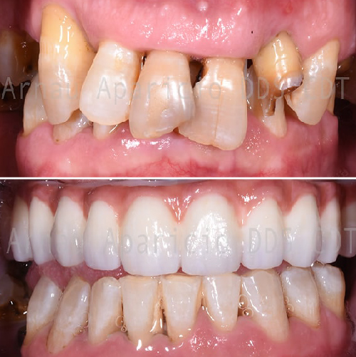 Dental implants & permanent zirconia bridge. Teeth whitening-03