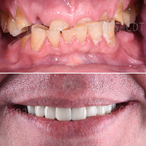 Dental implants. Permanent bridge in a very short time-14