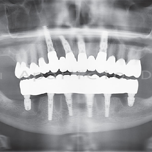 Dental implants. Permanent bridge in a very short time-15