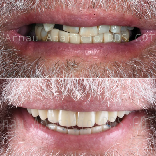Dental implants. Teeth whitening-16