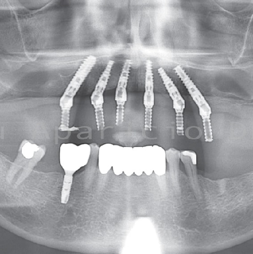 Dental implants. Teeth whitening-18