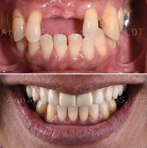 Dental implants. Zirconia bridge-05