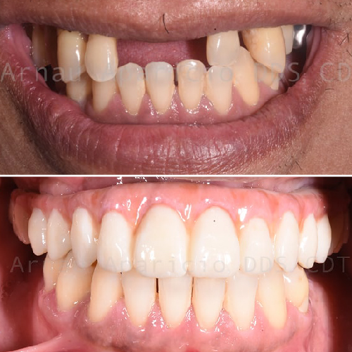 Dental implants. Zirconia bridge-06