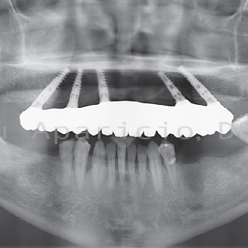 Dental implants. Zirconia bridge-07