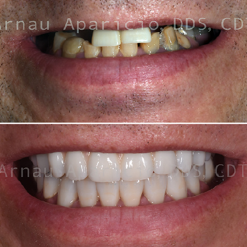 Dental implants. Zirconia bridge. Dental Crowns-08