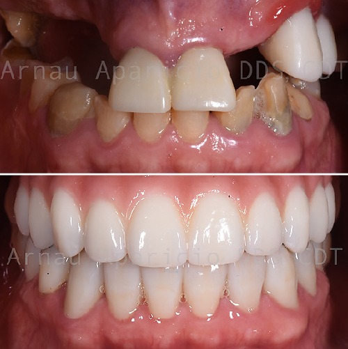 Dental implants. Zirconia bridge. Dental Crowns-09