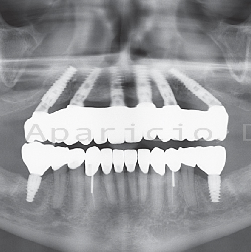 Dental implants. Zirconia bridge. Dental Crowns-10