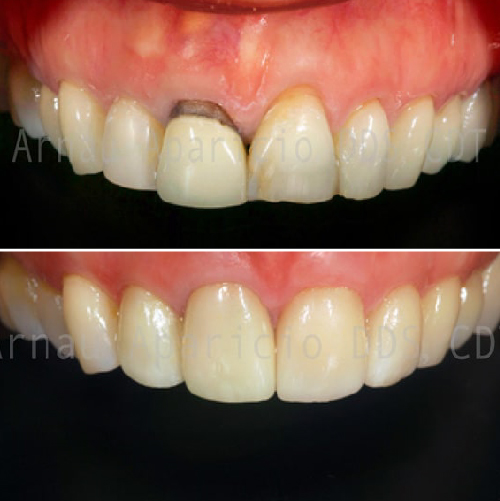 Root canal retreatment. New crown. Dental veneers-21