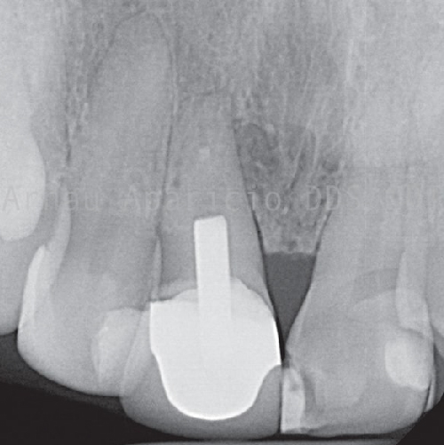 Root canal retreatment. New crown. Dental veneers-22
