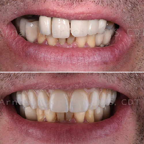 Tooth implants & permanent zirconia bridge-11