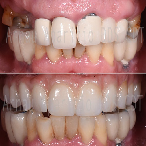 Tooth implants & permanent zirconia bridge-12