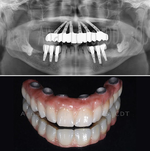 Tooth implants & permanent zirconia bridge-13