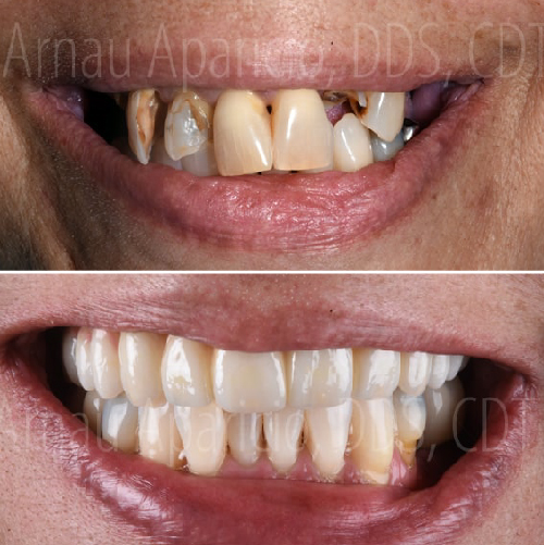 Tooth implants & permanent zirconia bridge-23